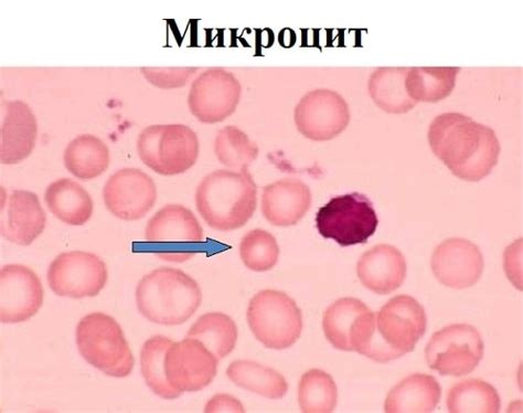 Определение и причины микроцитоза
