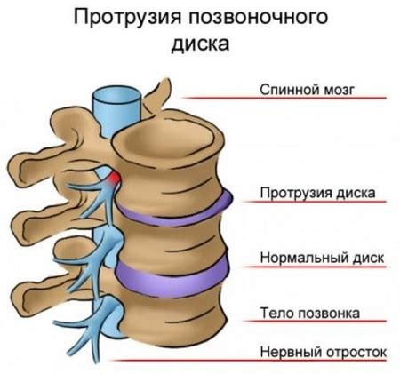 Осложнения и последствия поражения межпозвоночных дисков шморля