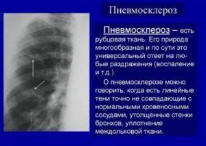 Осложнения неравномерной пневматизации легочной паренхимы