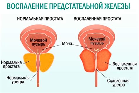 Основные аспекты функционирования предстательной железы у представителей мужского пола