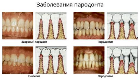 Основные подходы к восстановлению костной ткани при пародонтозе