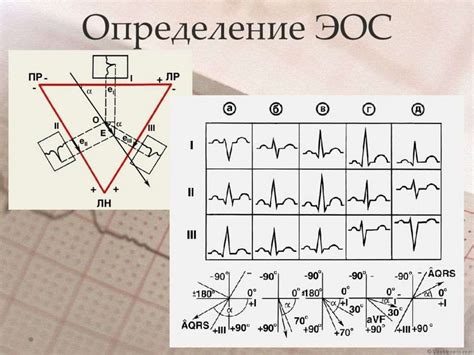 Основные признаки и значение полувертикальной Эос на ЭКГ