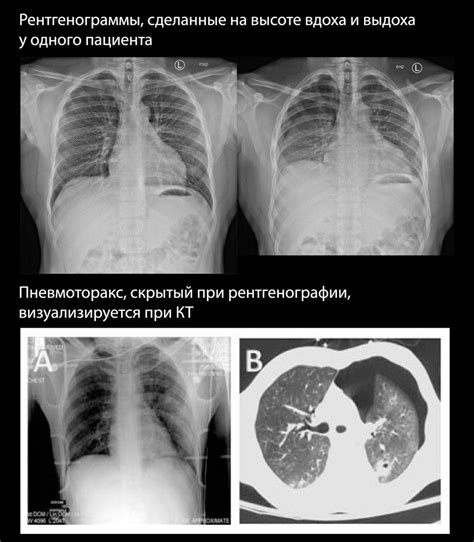 Основные причины и симптомы уплотнения альвеоларного островка на рентгенографии 