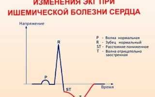 Основные причины нарушений реполяризации на ЭКГ