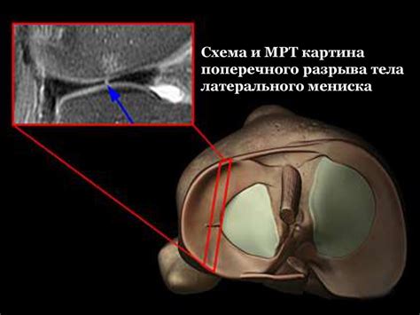 Основные проявления дистрофических изменений в структуре менисков коленного сустава