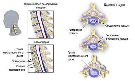 Основные симптомы нестабильности сегментов C2-C6