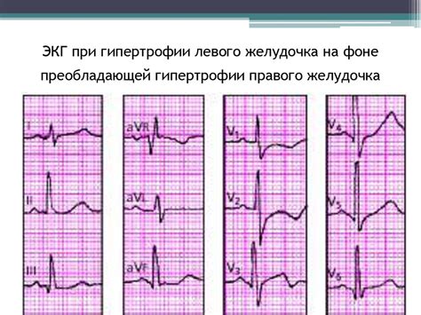 Основные типы изменений структуры левобокого желудочка на записи ЭКГ
