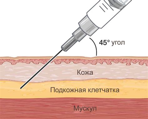 Основные шаги для устранения неправильно выполненной инъекции в заднюю часть