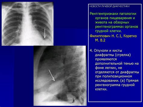 Особенности диагностики распространенных изменений на рентгенограммах грудной клетки