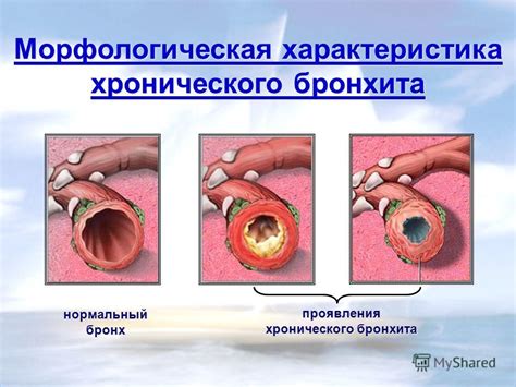 Особенности хронического бронхита и его характерные проявления