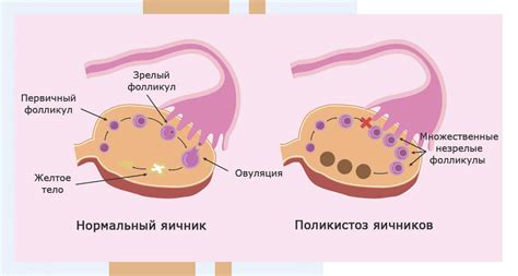 Отсутствие овуляции при наличии мультифолликулярных яичников