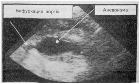 Пальцевое исследование для обнаружения аневризмы в области брюшной аорты