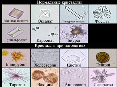 Патологические факторы, способствующие образованию неизвестных кристаллов в моче