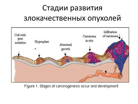 Повышенная вероятность развития злокачественных опухолей кожи