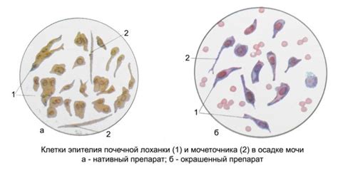 Повышенный уровень клеток плоского эпителия в моче: возможные причины