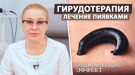 Подготовка к уходу за медицинскими пиявками