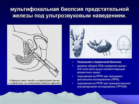 Подходы и методы по проведению процедуры рассмотрения состояния предстательной железы