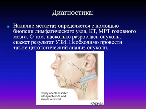 Получение информации о состоянии лимфатического узла с помощью биопсии