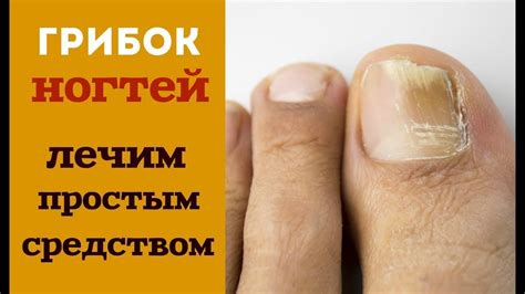 Популярные народные рецепты для устранения утолщения ногтей на стопе