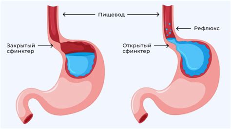 Последствия отсутствия желчи в желудке