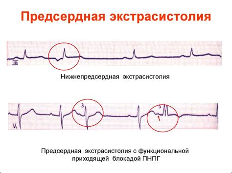 Предсердная экстрасистолия: что это такое?