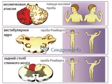 Прелюдия к цефалгическому синдрому вестибулоатактического