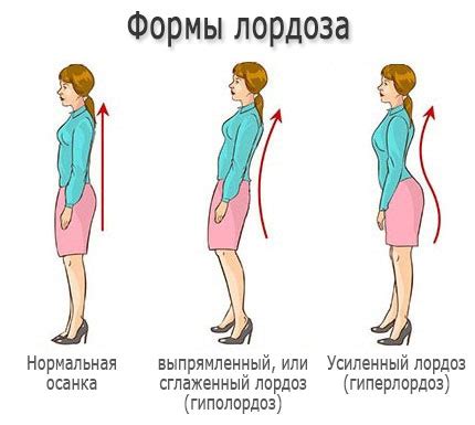 Преодоление гиперлордоза поясницы у маленького пациента без применения медикаментов