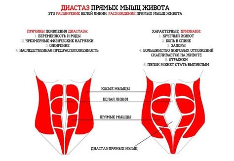 Признаки диастаза: как распознать синдром сепарации прямых мышц брюшного пресса?