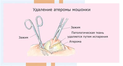 Применение массажа для исключения атеромы: подходы и преимущества