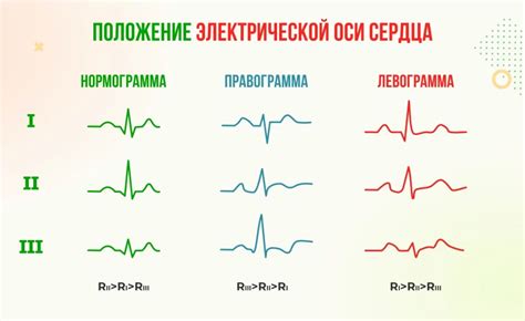 Принцип работы Эос полувертикальной и ее отображение на ЭКГ