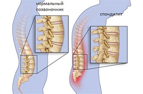 Причины возникновения неспецифического спондилита позвоночника