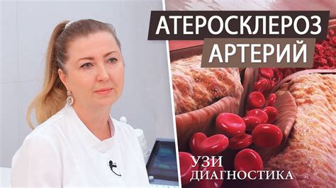 Причины возникновения нестенозирующего атеросклероза брахиоцефальных артерий