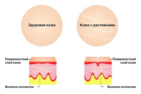 Причины возникновения растяжек у малышей