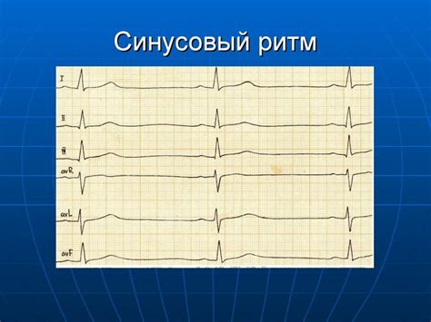 Причины нерегулярного синусового ритма