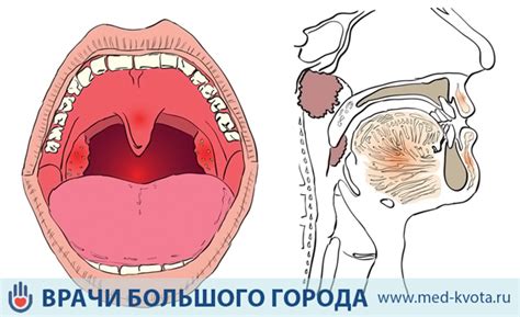 Причины несмыкания голосовых связок