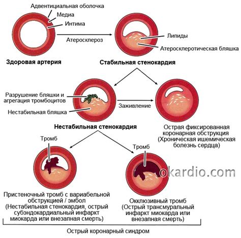 Причины нестабильной прогрессирующей стенокардии