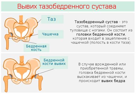 Причины отсутствия смазки в тазобедренном суставе: