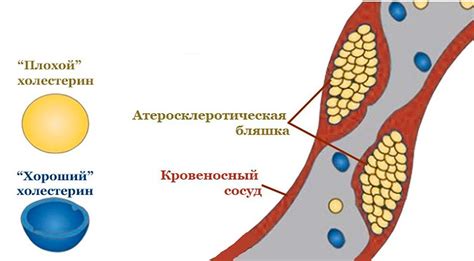 Причины повышенного уровня холестерина "вредного типа"