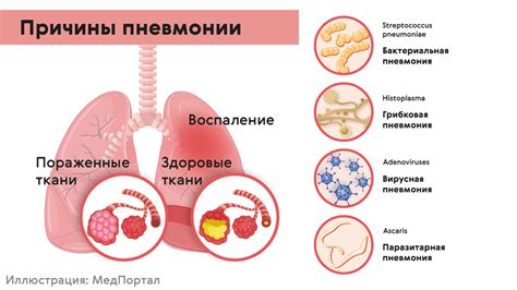 Причины снижения аппетита при пневмонии