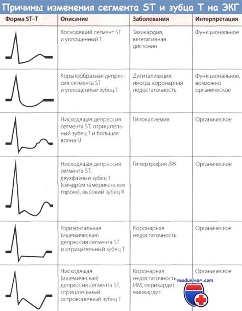 Причины сокращения pq на электрокардиограмме