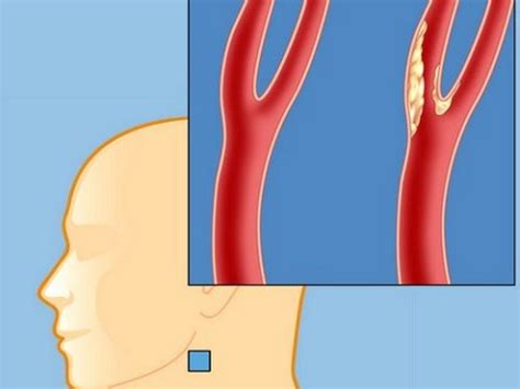 Причины стеноза сосудов шеи и факторы риска