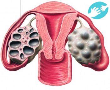 Проблемы, связанные с мультифолликулярными яичниками