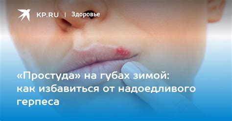 Простуда на губах и ее возникновение: основные аспекты