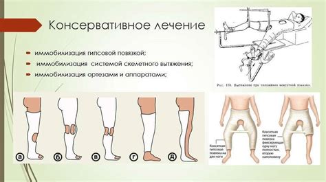 Профилактика несращивания перелома