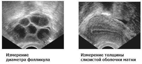 Профилактические меры отсутствия фолликулов в яичниках