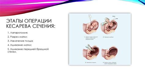 Процесс осуществления операции кесарева сечения