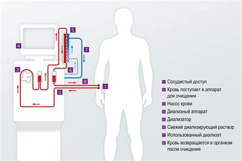 Процесс очистки крови в аппарате гемодиализа