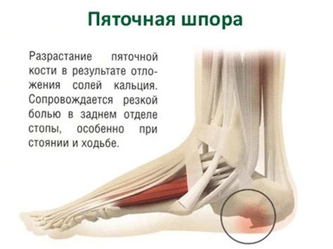 Пяточная шпора: возможные причины и основные сигналы тревоги