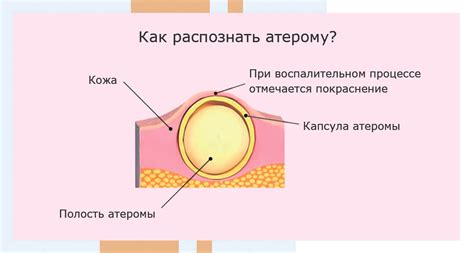 Развитие атеромы на брюшной стенке: этапы и методы лечения