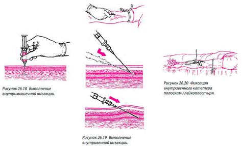 Рациональное введение препарата с шприцем: лучшие практики